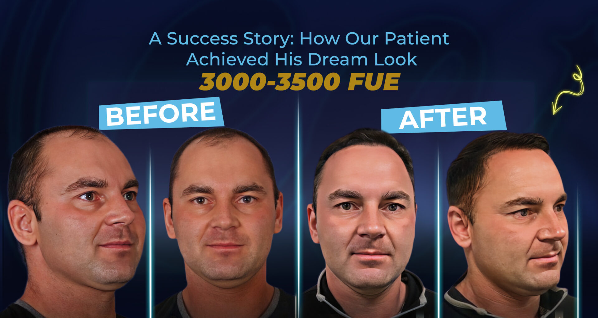 Témoignage de réussite : résultats d’une greffe de cheveux FUE