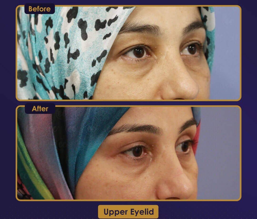 Upper eyelid lift before and after