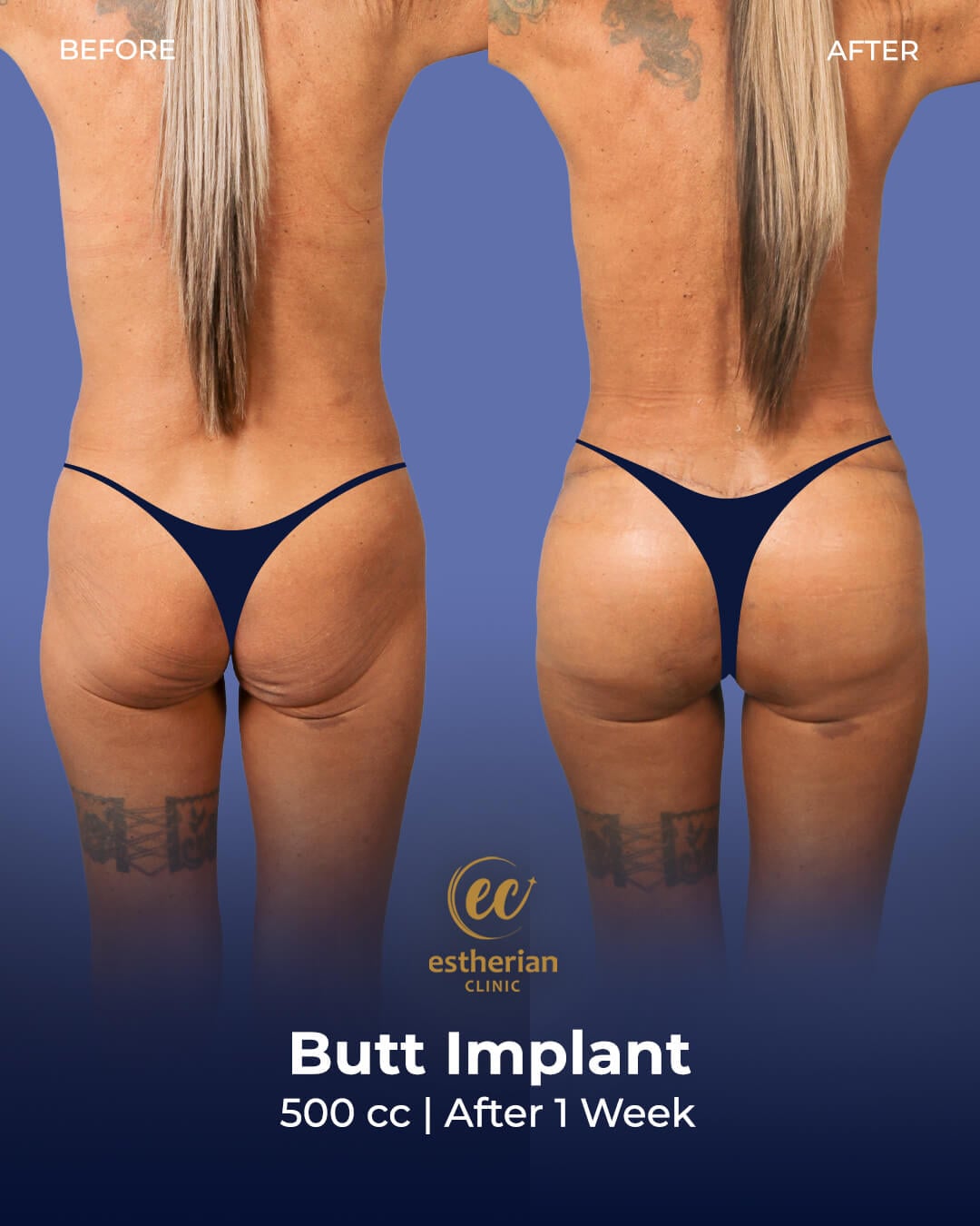 Butt Implant (500cc) Before and After – Estherian Clinic