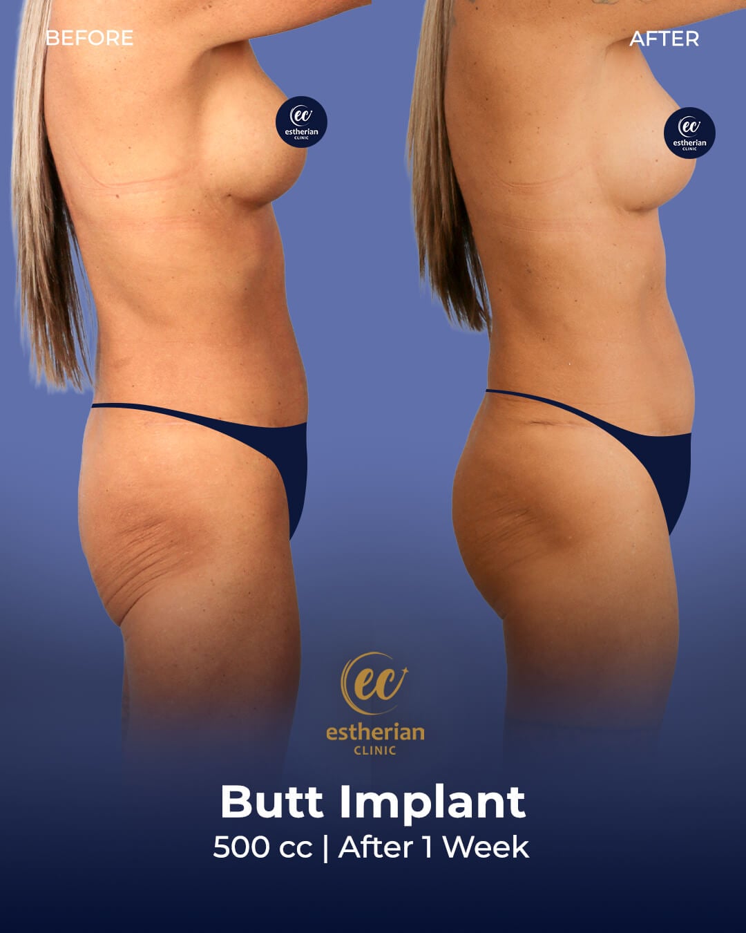 Butt Implant (500cc) Before and After – Estherian Clinic