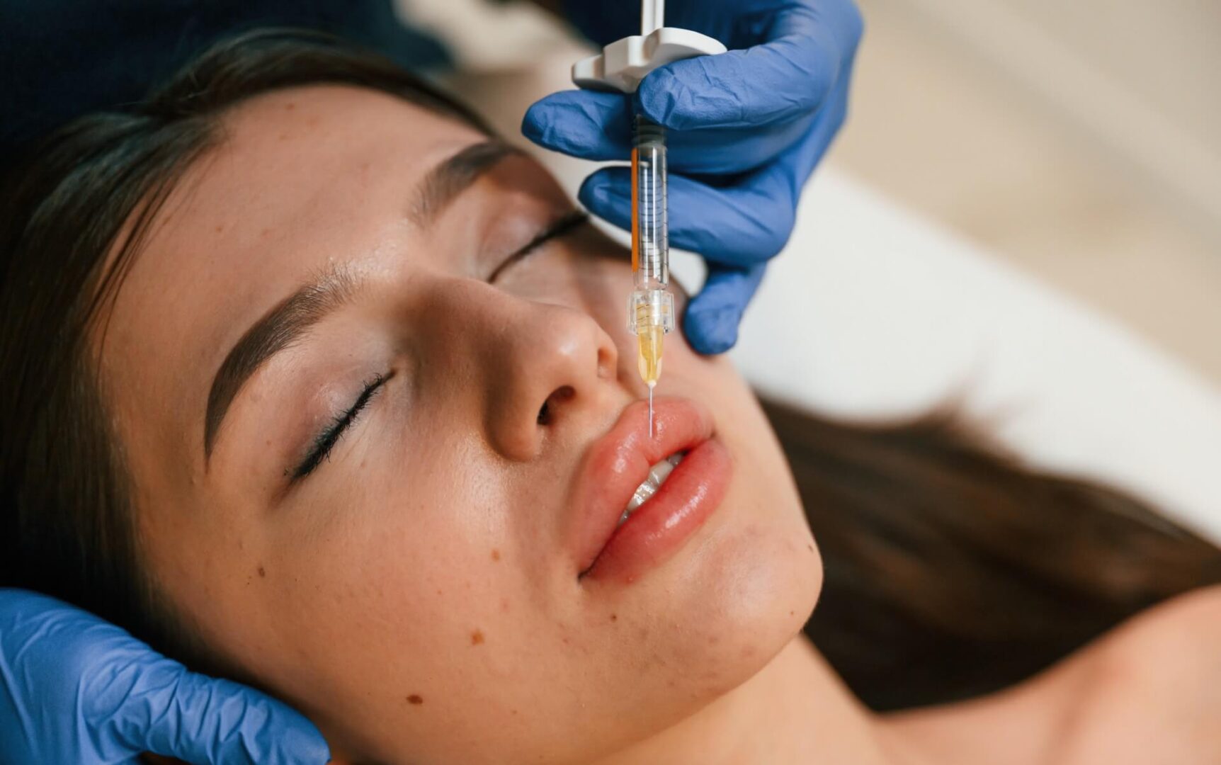 Lip Augmentation