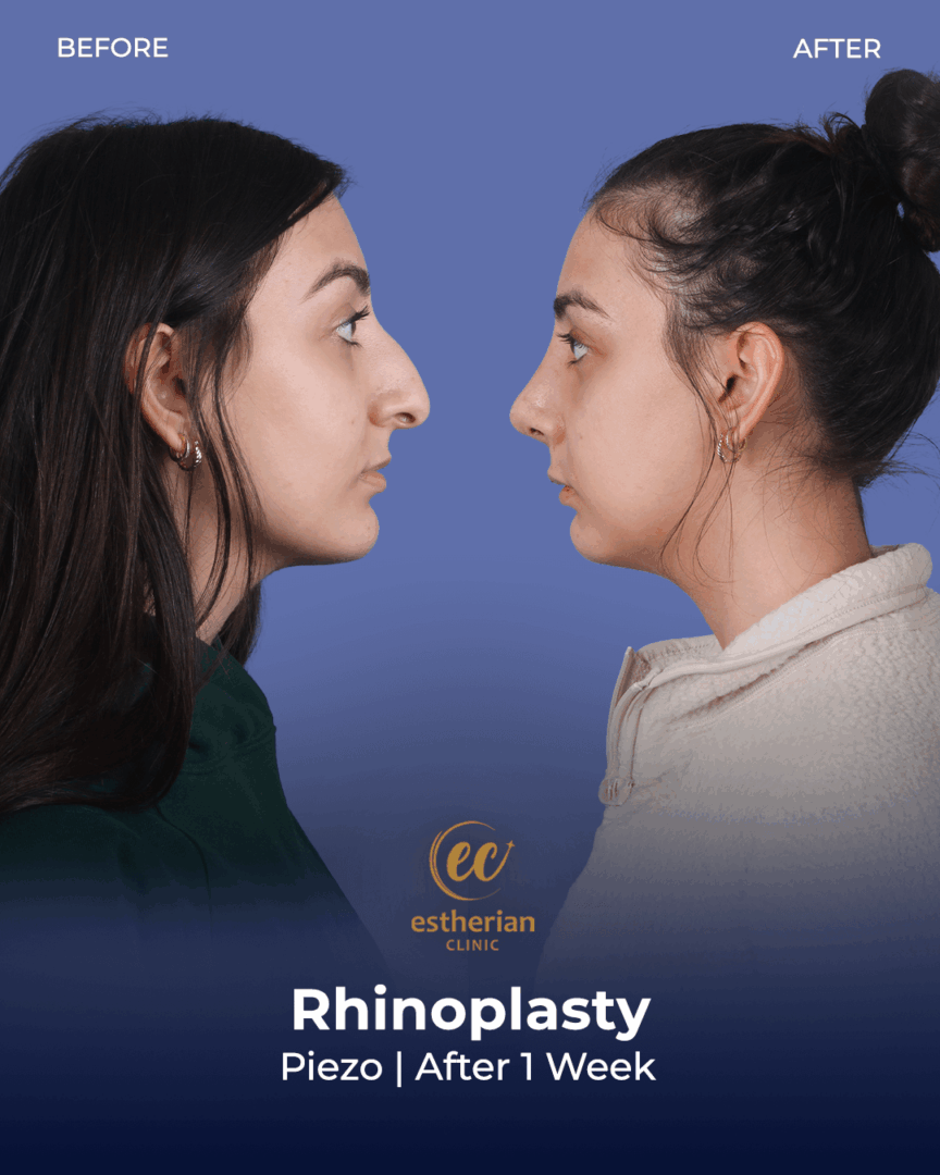 rhinoplasty after 1 week