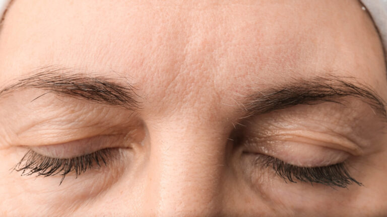 Eyebrow Sagging Correction