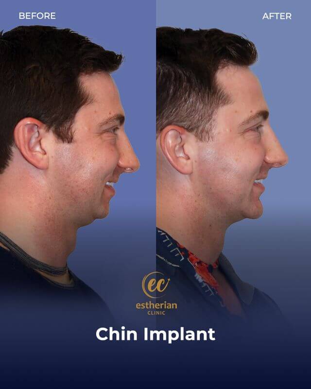 Chin Implant for men before and after