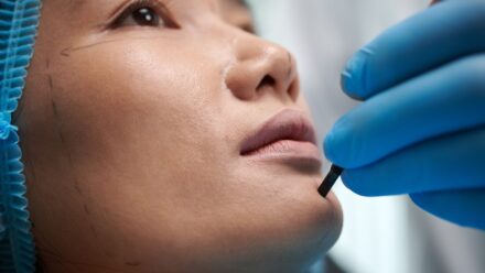 Chin Implant or Filler Which One Is Right for You