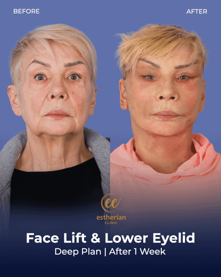 Deep Plane Facelift nach 1 Woche (vorher und nachher)