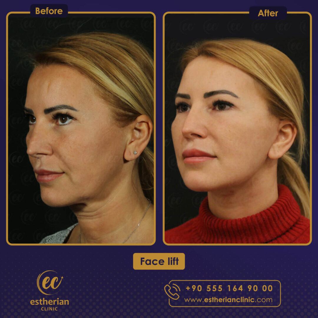 Face Lift (Estherian Clinic) before and after