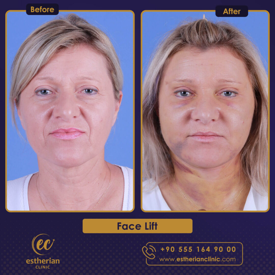 Facelift before and after