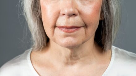 Fix Sagging Jowls Without Surgery – Non-Invasive Treatments