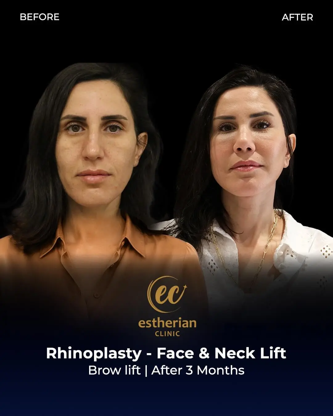 Rhinoplasty, Face and Neck Lift and Brow Lift (before and after) by the Estherian Clinic.jpeg