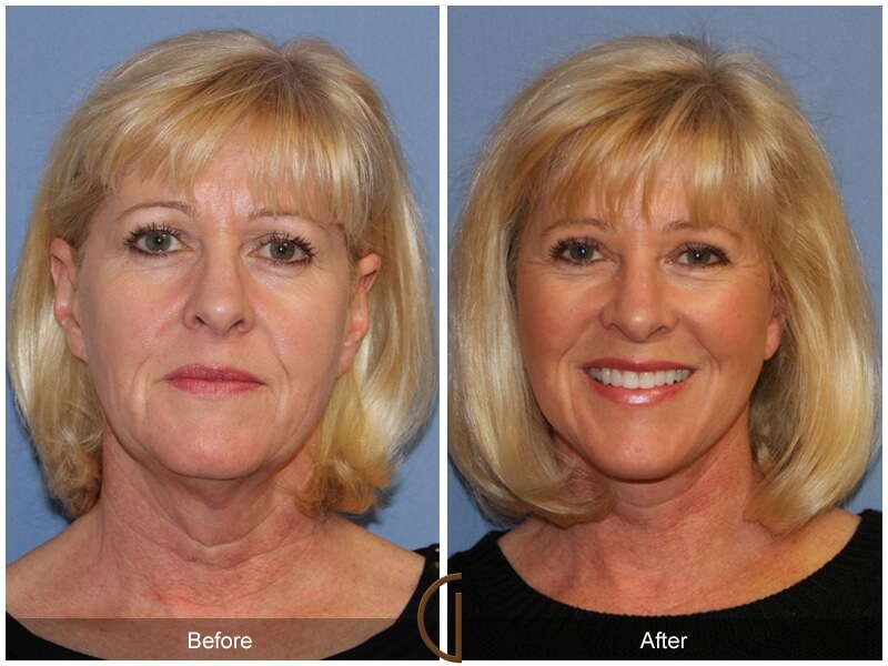 SMAS facelift, eyelid lift and facial fat grafting (before and after)