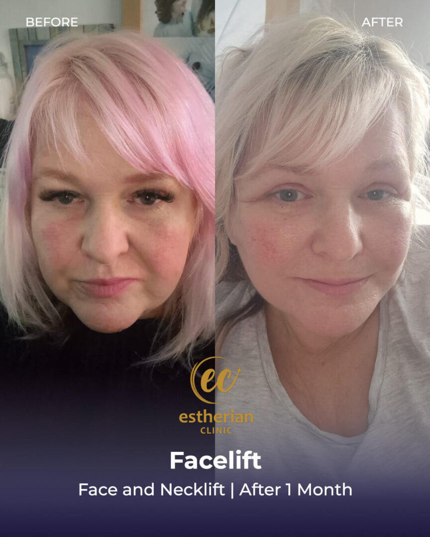 face and necklif surgery 1 months result