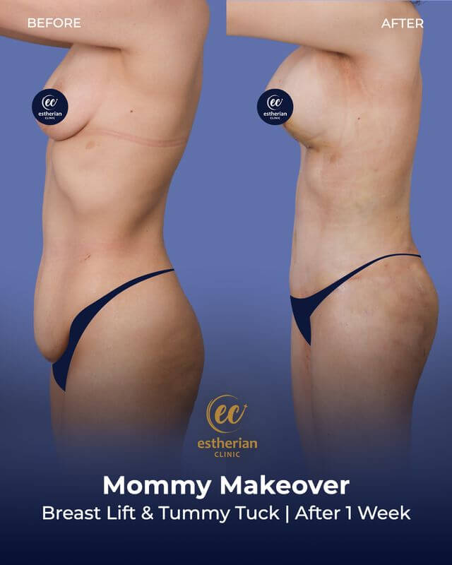 Breast lift and tummy tuck (after 1 week) Mommy Makeover before and after