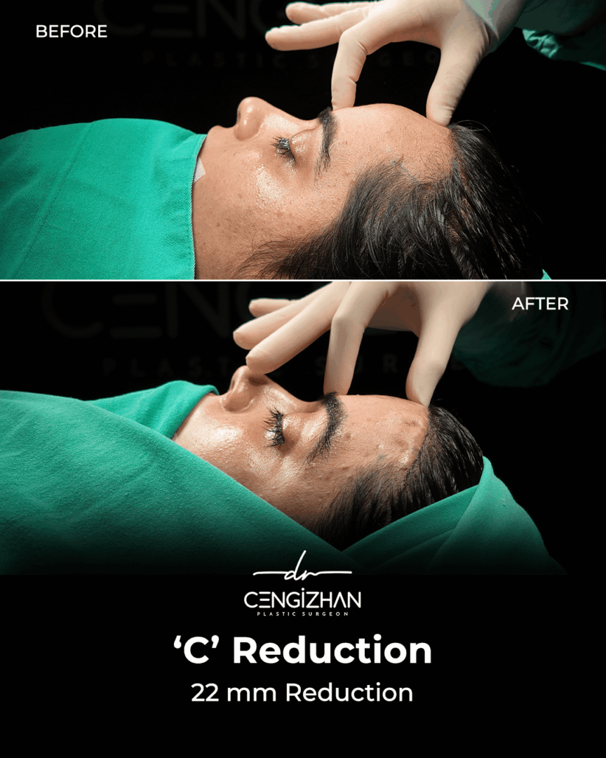 C-Reduktion (22 mm Reduktion) vorher und nachher (von Dr. Cengizhan)