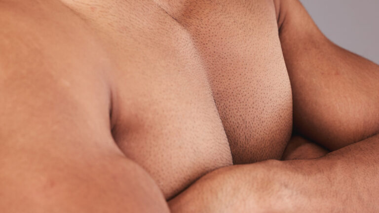 Fatty Breast Tissue – Gynecomastia Surgery Recovery Guide