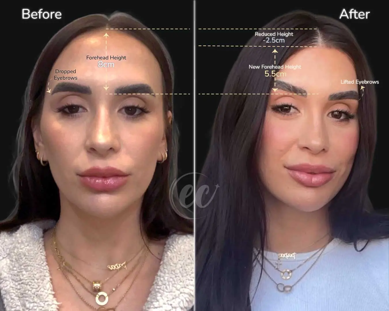 Forehead Reduction and Borw Lift Case Study Photo (Real patient transformation by the Estherian Clinic).jpg