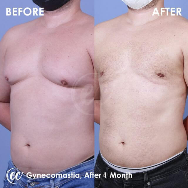 Gynecomastia results after 1 month (before and after)