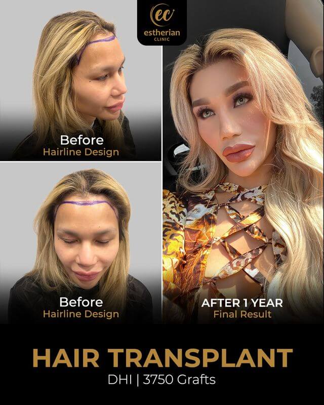 Hair Transplant for Women (DHI, 3750 GRAFTS) Before and after