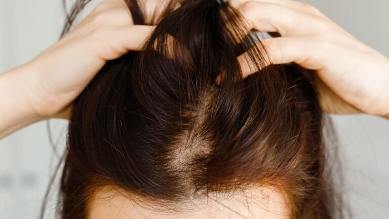 Hair Transplant for Women – Your Ultimate Guide