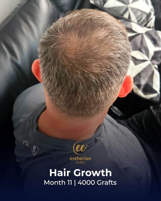 Hair growth (Month 11, 4000 Grafts)