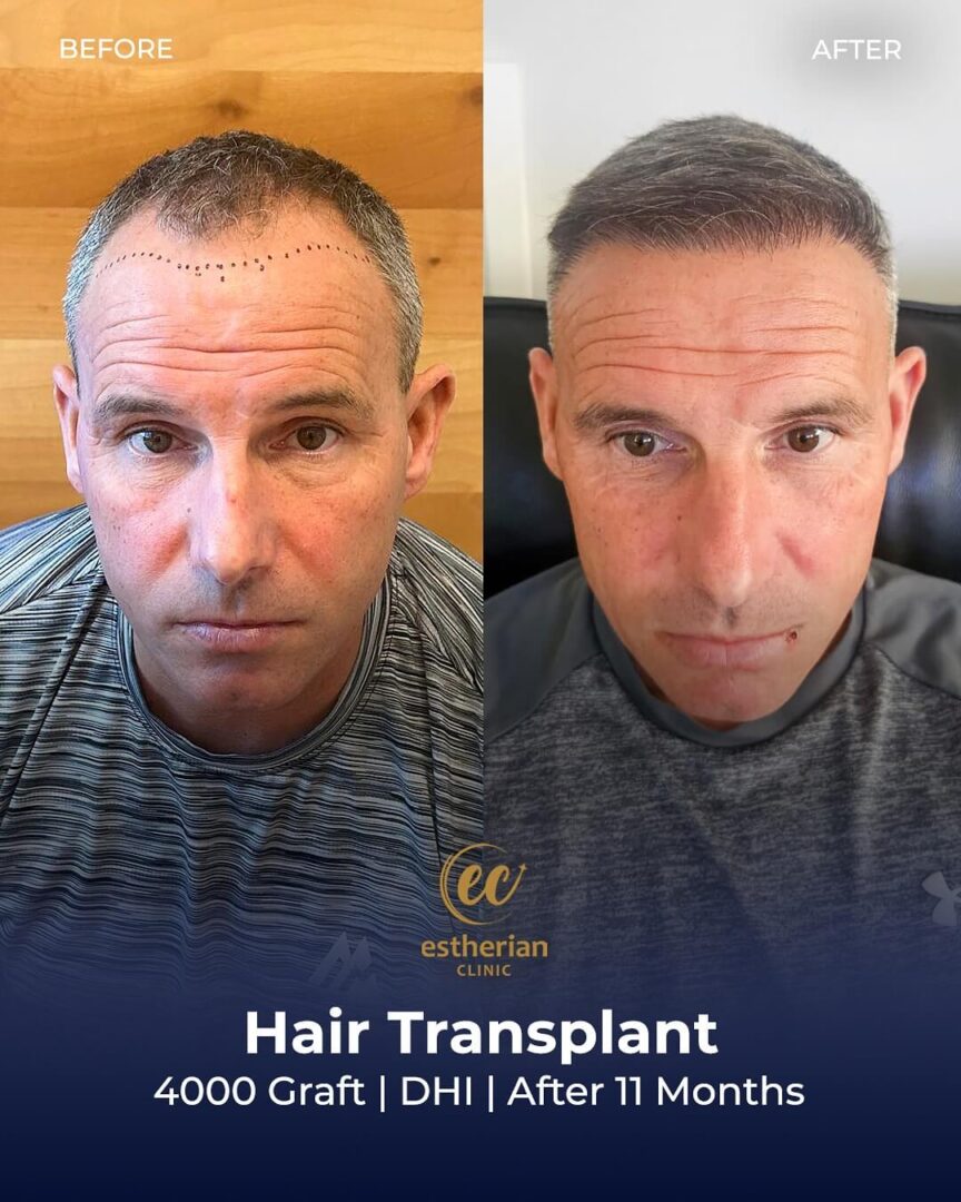 Greffe de cheveux (4000 greffons, DHI, après 11 mois)