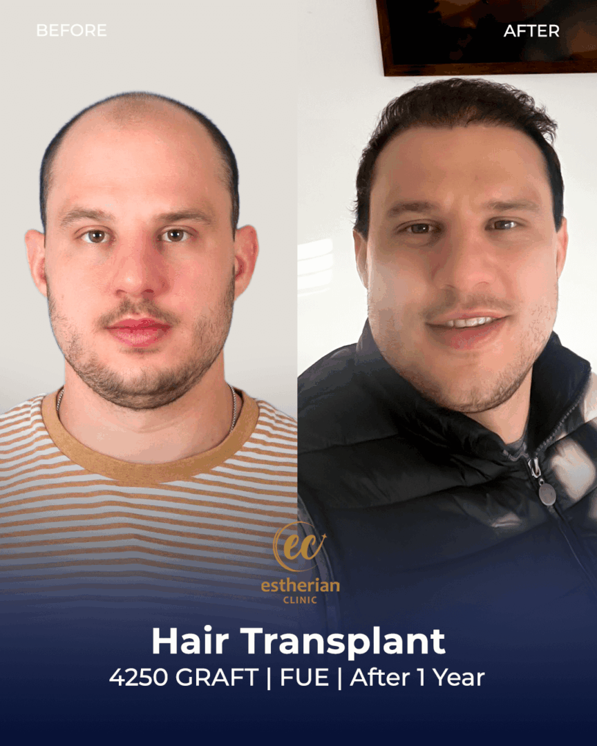 Greffe de cheveux 4250 greffons FUE (Après 1 an)