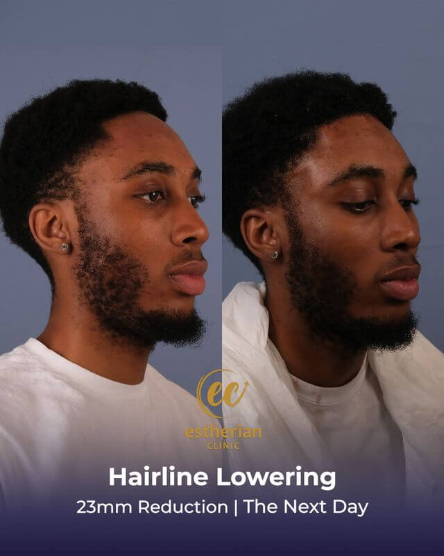 Hairline lowering (23mm reduction) The Next Day