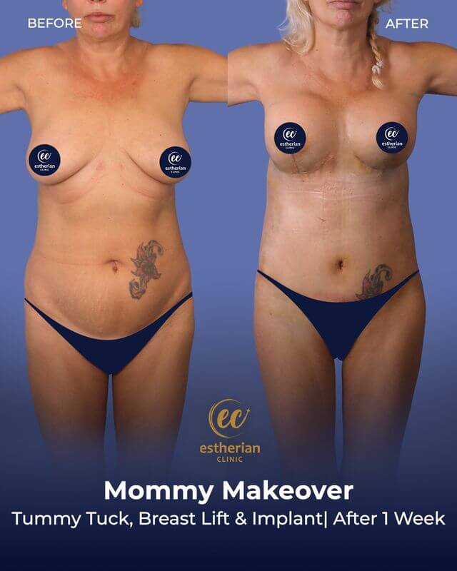 Tummy tuck, breast lift and implant results (after 1 week) Mommy Makeover