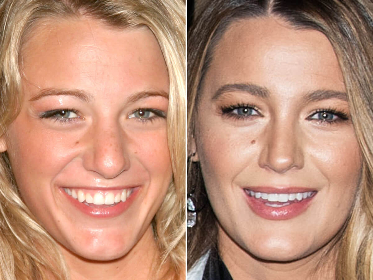 Blake Lively'nin öncesi ve sonrası