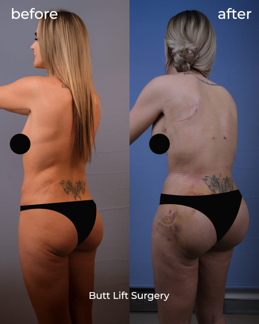 Butt lifting surgery result