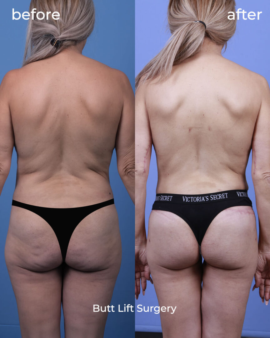 Butt lifting surgery before after