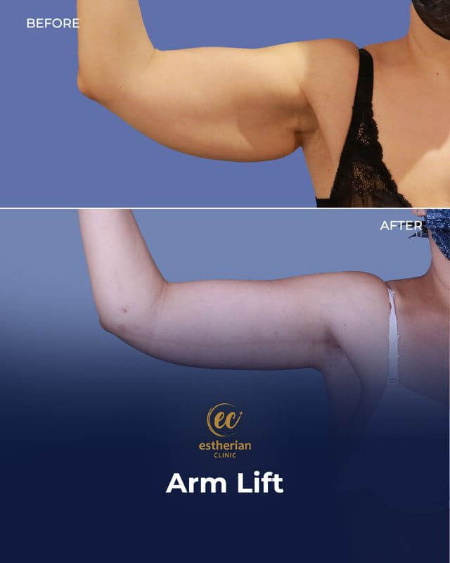 Arm Lift surgery before and after in Turkey at the Estherian Clinic