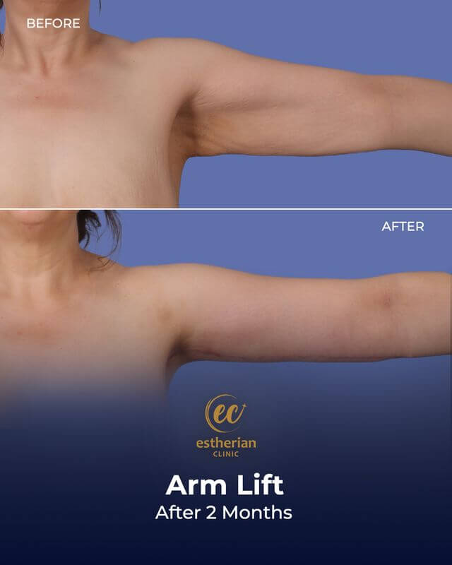 Arm lift surgery results (before and after) after 2 months