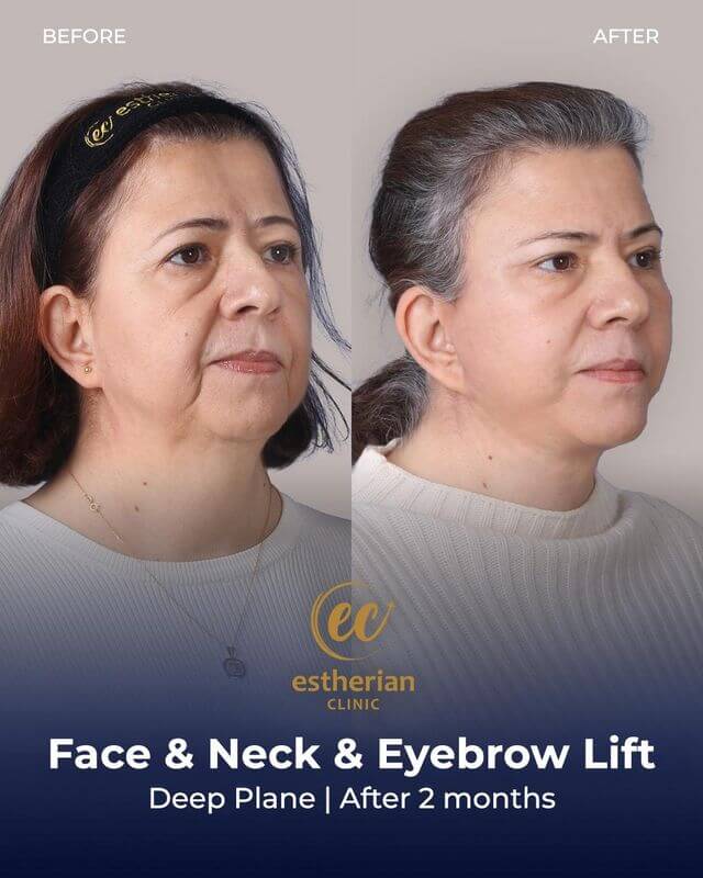 Lifting du visage, du cou et des sourcils (avant et après) plan profond, après 2 mois