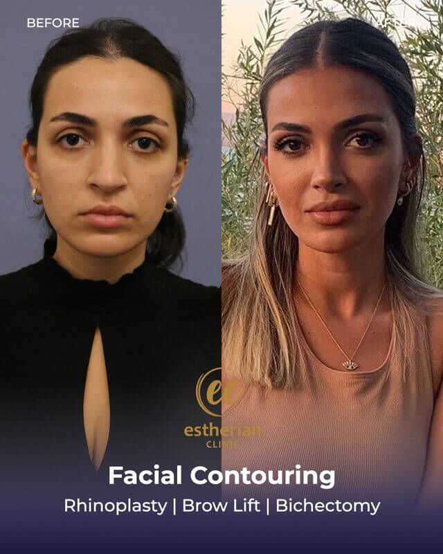 Facial Contouring before and after (rhinoplasty, brow lift and bichectomy)