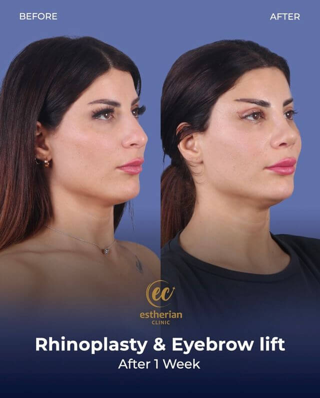 Rhinoplastie et lifting des sourcils (après 1 semaine)
