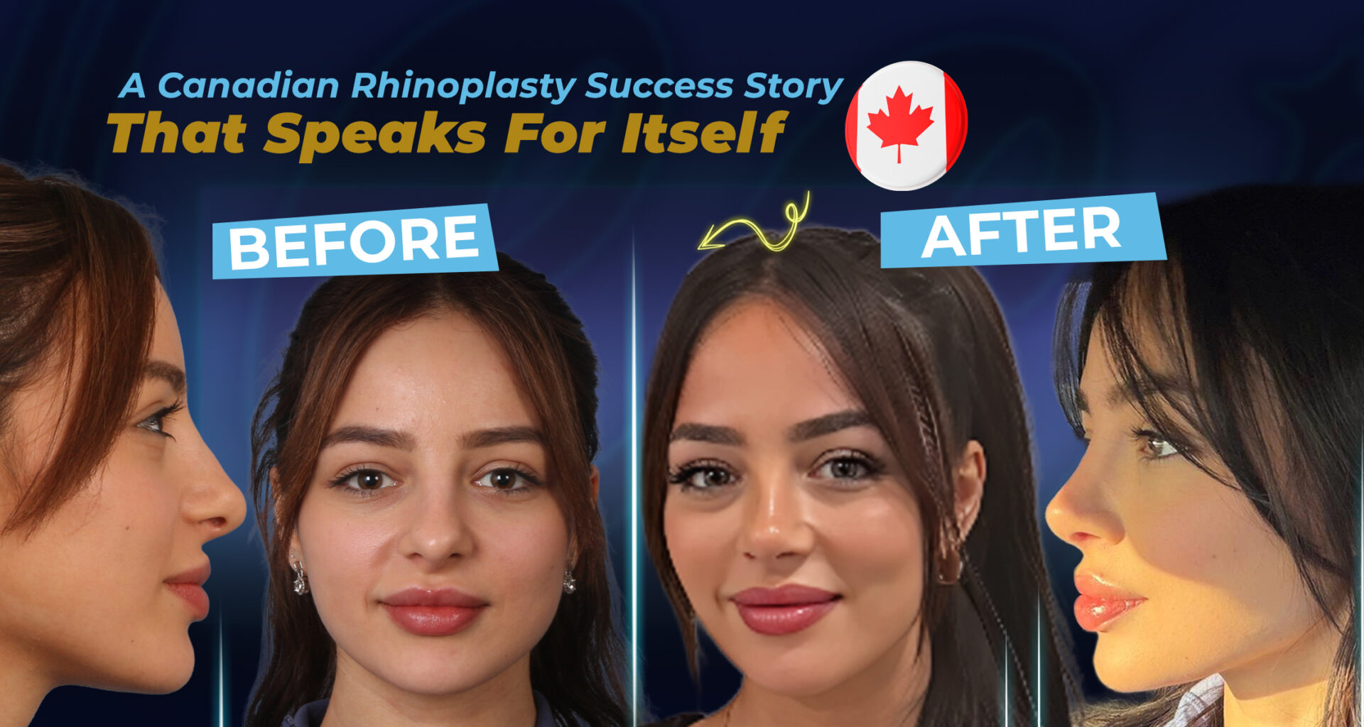 عملية تجميل الأنف (قصة نجاح مريض من عيادة إستيريان)