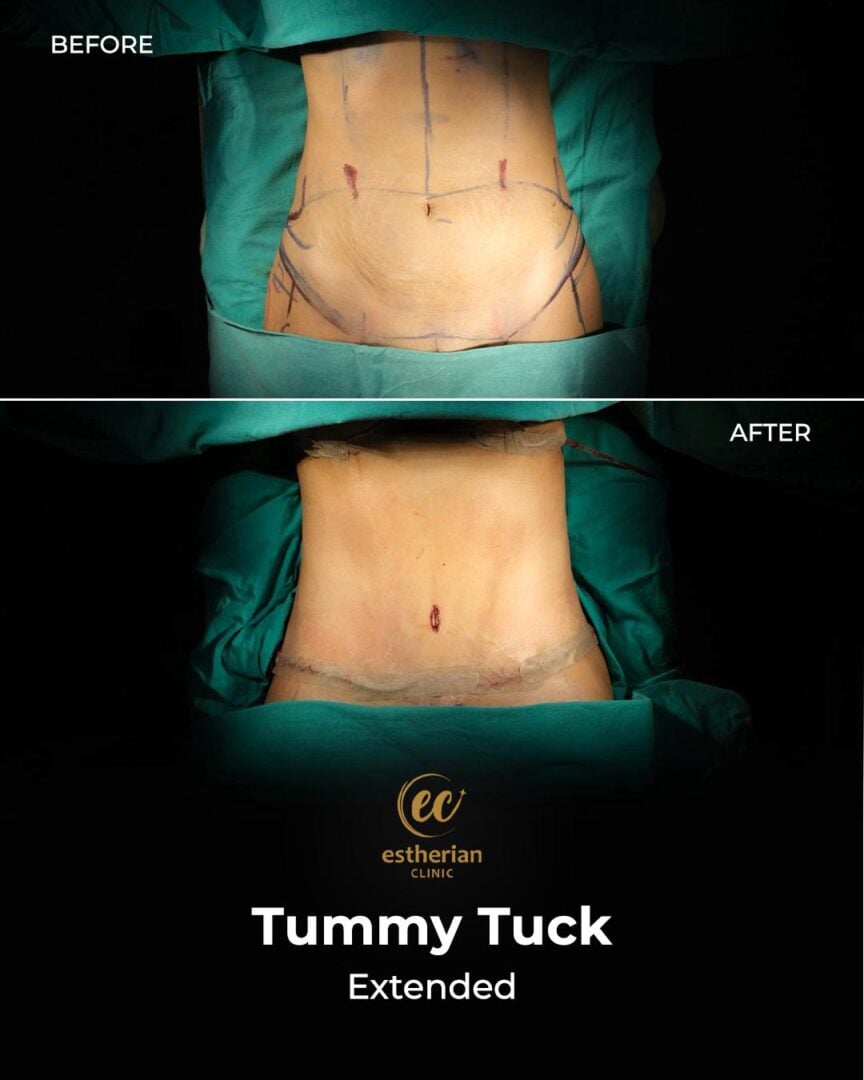 TUMMY TUCK-TUMMT TUCK-Photo 29.07.2025, 21 37 09 (5) – Estherian Clinic