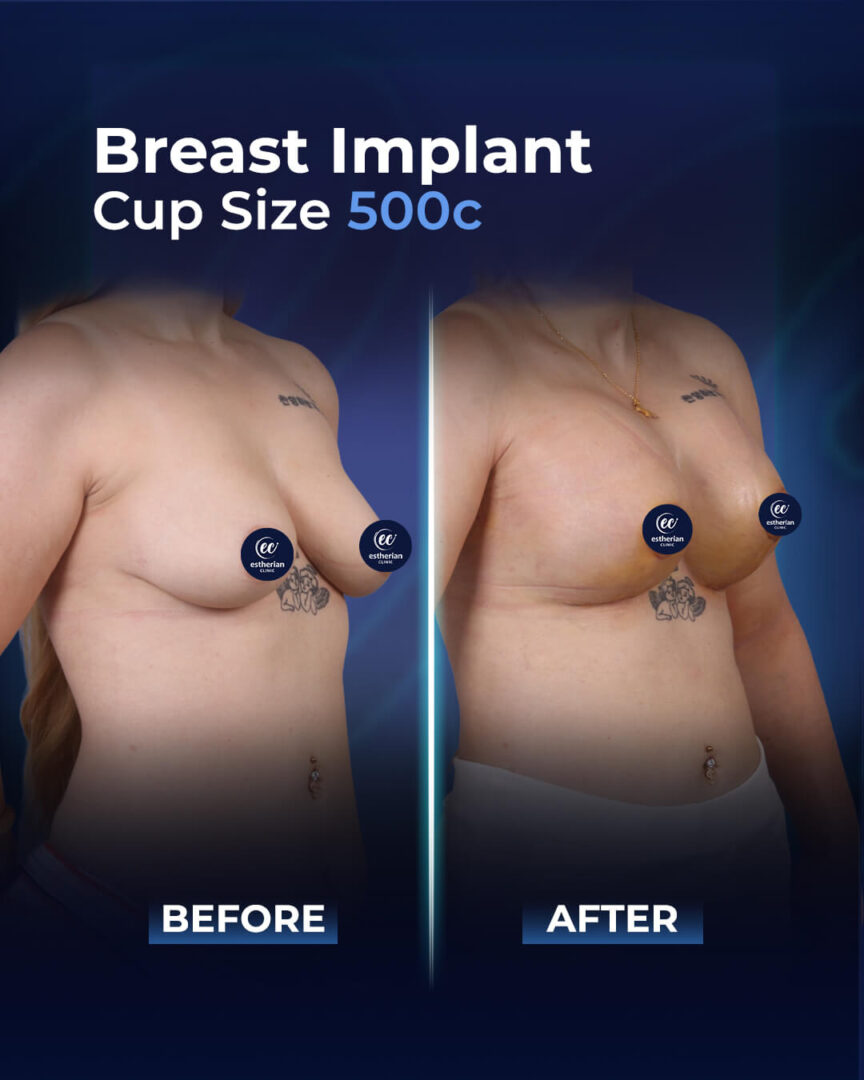 Résultats de l'implant mammaire 500cc à la clinique Estherian (avant et après)