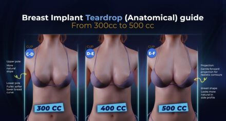 500cc Breast Implants Before And After Estherian Clinic 500cc-breast-implants-before-and-after-estherian-clinic