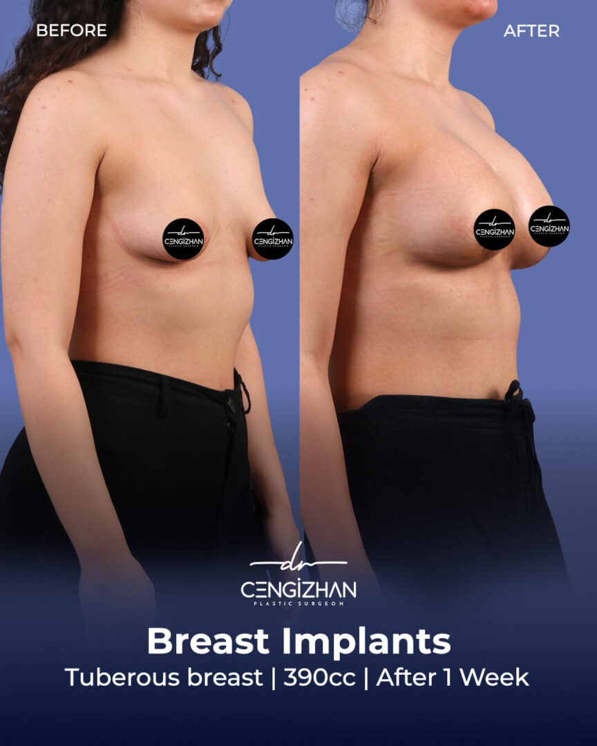Breast Implant (390cc) Results after 1 week