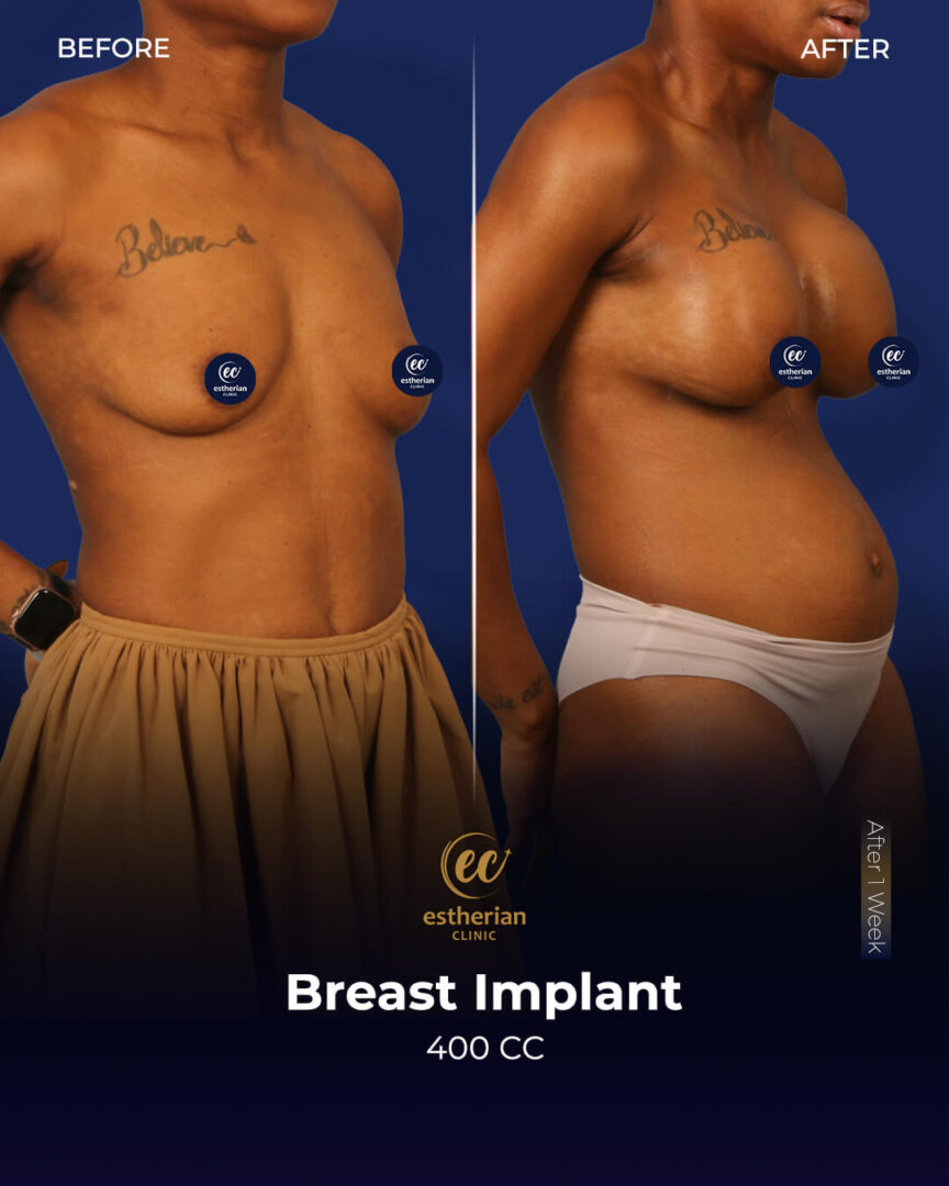 Breast Implants 400cc (before and after) by the Estherian Clinic