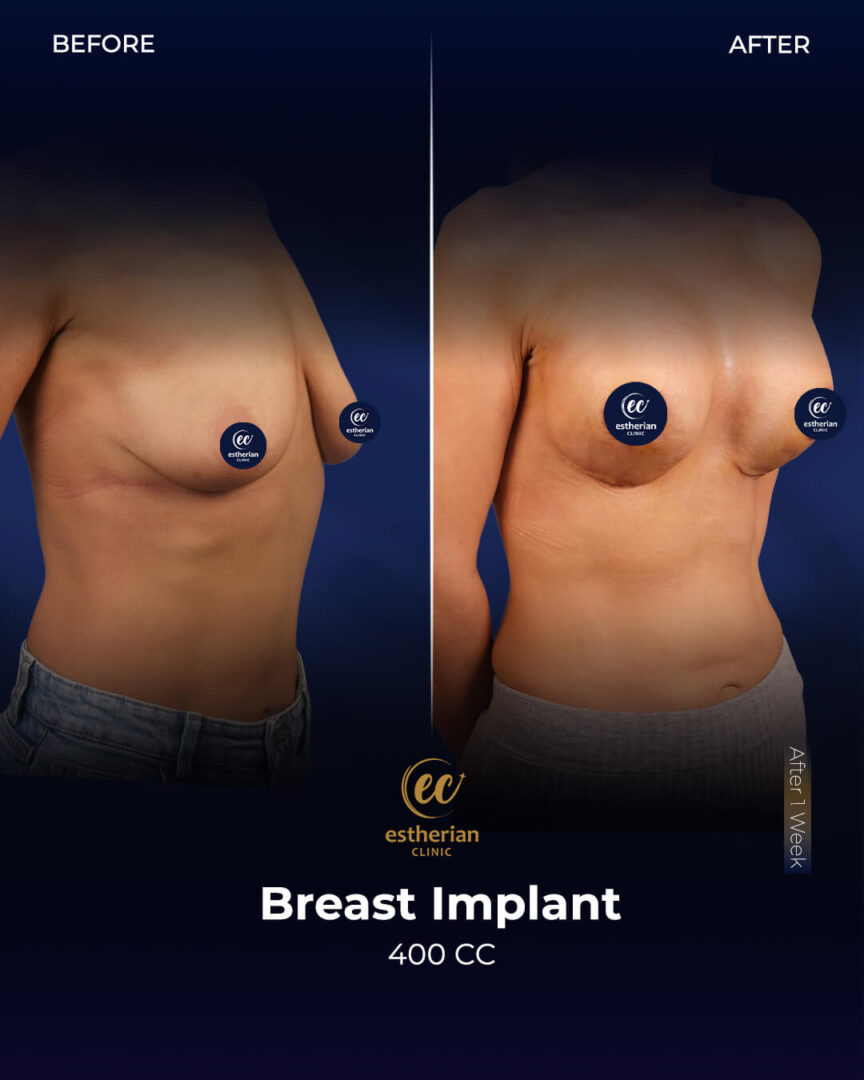 Breast Implants 400cc by the Estherian Clinic (before and after)