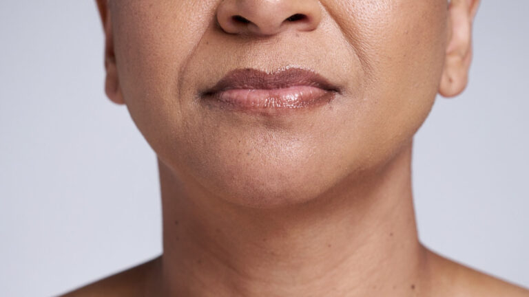 Chin Lipo Results What to Realistically Expect