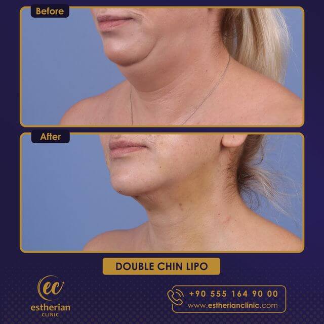 Double chin lipo (before and after) the Estherian Clinic (surgery results)