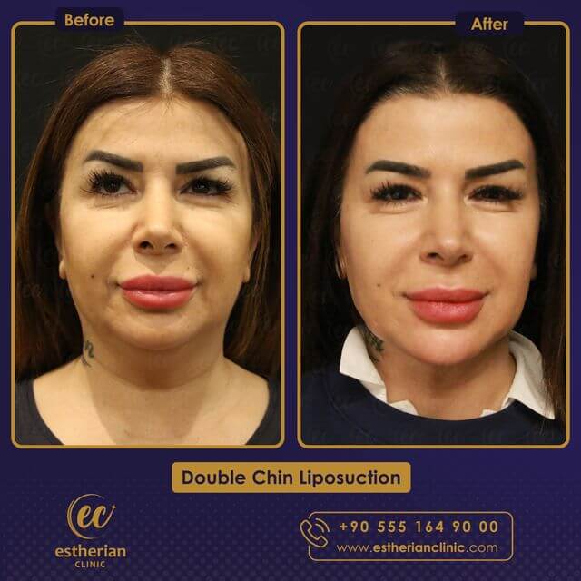 Double chin liposuction (before and after) by the Estherian Clinic