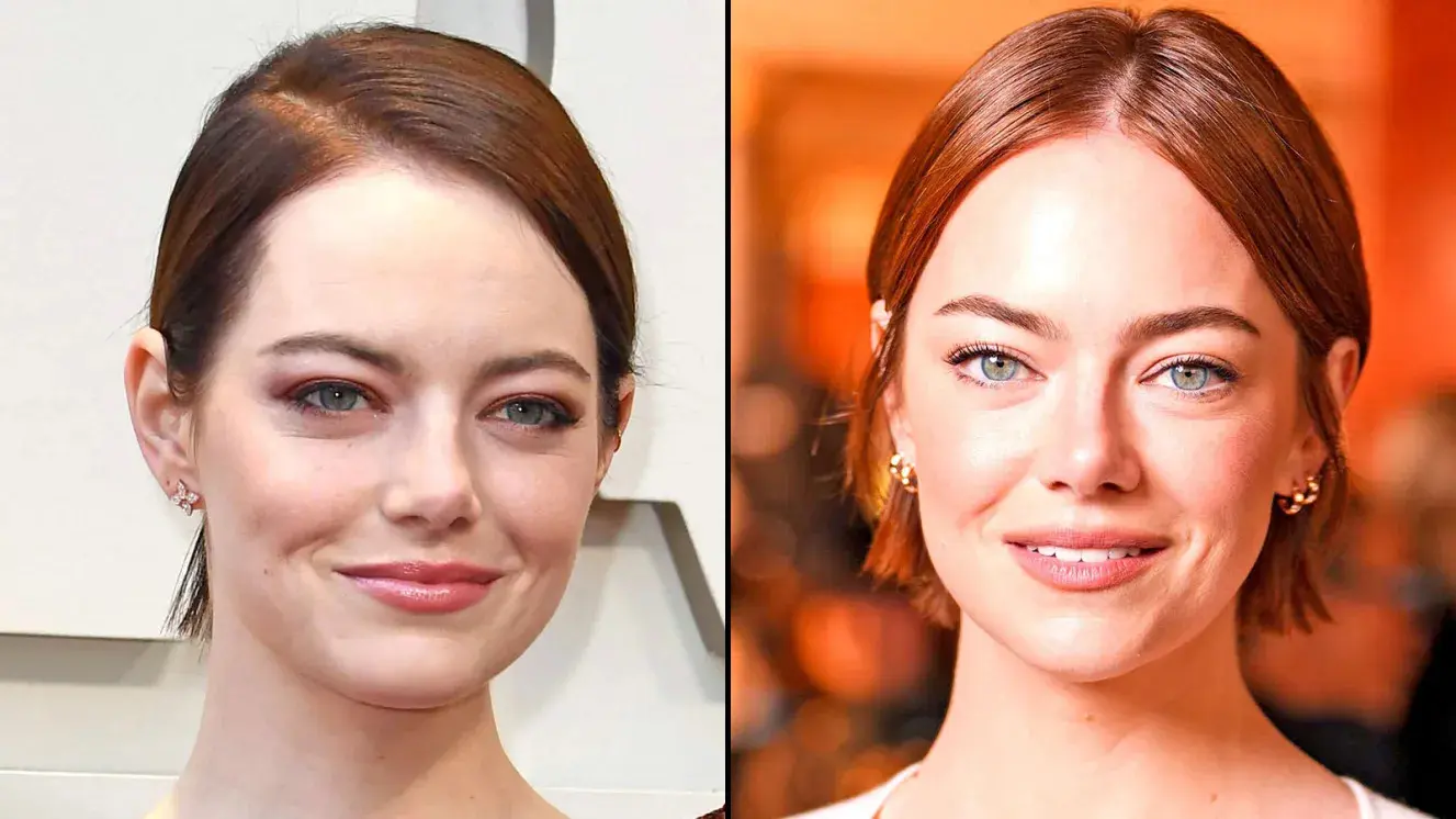 Emma Stone Facelift