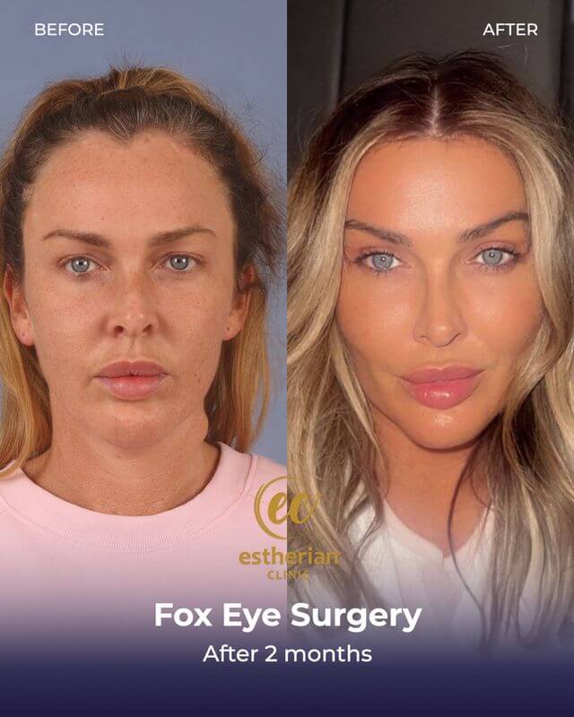 Chirurgie oculaire de renard, canthoplastie (après 2 mois) résultats avant/après par la clinique Estherian