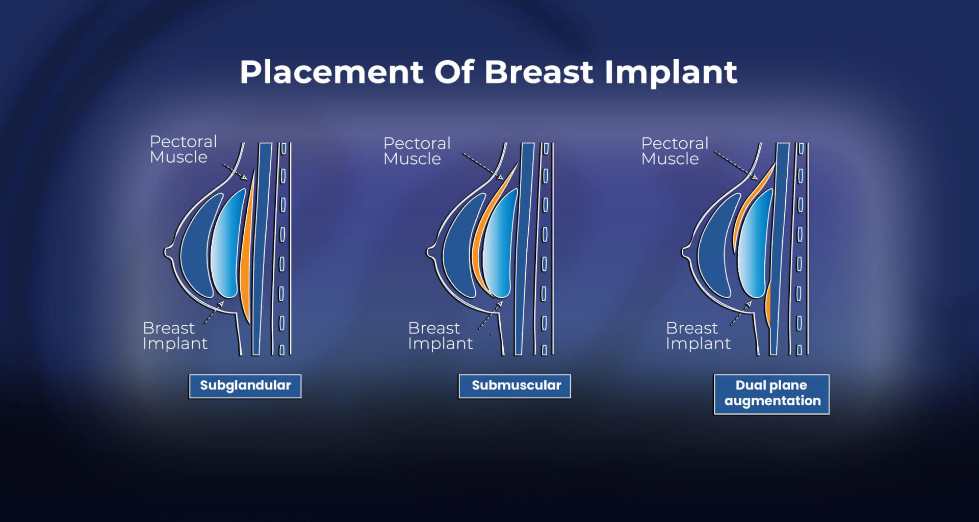 Infographic: Placement of Breast Implants