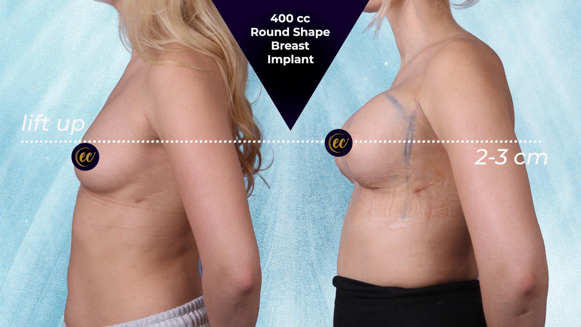 breast implant 400cc side (before and after) by the Estherian Clinic